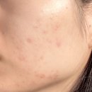 영천시립도서관 | 영천 스킨봄 피부관리🌸 여드름•흔적 케어 후기