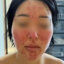 나을한의원 | 지루성피부염 한의원 치료 내돈내산 후기