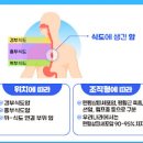 식도암 초기 원인 이미지