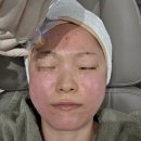 흥터입구 | 내돈내산 압구정역 피부과 포텐자 펌핑팁 재생 효과 후기