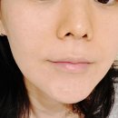 선두 | [강동피부관리/고은결에스테틱]여드름관리부터 손길부터 남달랐던 신부. 윤곽관리 선두주자 솔직후기