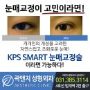 곽앤지성형외과 | 범계성형외과, 수원성형외과 - 눈매교정후기