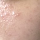 예고은피부과의원 | 인덕원 피부과 후기