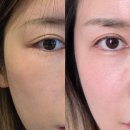 삼성역 피부과 써마지 한 달 후기 정품