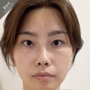 200 | 부산피부과추천 눈밑꺼짐 내돈내산 서면 울트라콜200 후기