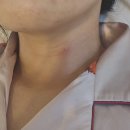 호스텔 클로이 | 20250812 - 7월달 한국 간 걸 내가 어 떻 게 기억하냐고: 1. 갑상선 총생검 누가 미리 총으로 쏘는 거...