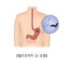 위장병의 천적 - 헬리코박터균 감염(Helicobacter pylori infection) 이미지