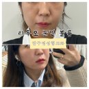 압구정성형외과 엘라비에 리투오 눈밑꺼짐 통증, 주기, 부작용 내돈내산 솔직후기