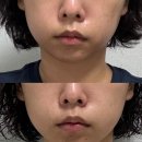 포커스 | 메디큐브 하이포커스샷 플러스 사용 후기 aka하포플