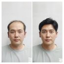 안양가발 착용 후 100% 달라진 모습, 30대부터 60대까지 만족하는 후기