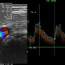 경동맥 초음파의 기술적인 문제 이미지