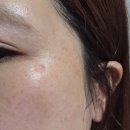 기미 스트레스 끝! 메디필 루비알엔앰플클렌저 사용후기 1주일만에 환해진 피부광채