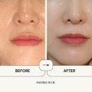 압구정피부과 예스필 저자극 6세대필링 직접 받아봤어요! 내돈내산