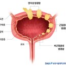 중년의 혈뇨가 더 위험한 이유 이미지