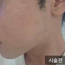 진**-1 | 천호피부과 젠틀맥스프로 제모 남자수염 스트레스 줄이고 깔끔해진 1주일차 후기