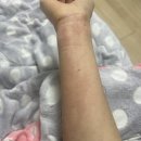 갑자기 쓰는 1도 화상 후기