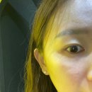 피자마루영등포남부역점 | 양천구 여드름 관리 추천 | 솔에스테틱 영등포점 좁쌀 여드름 관리 후기