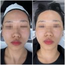 셀레나 뷰티 | 마산윤곽관리 ‘셀레나뷰티’ - 페이스핏톡스 후기