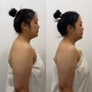 핏랩 | 광주에스테틱 광주 팔뚝관리 | 연아스킨랩에서 받은 라인핏 슬리밍 1회 후기