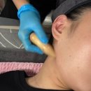 이혈 테라피 | 대구 달서구 피부관리 '에벤에셀 피부앤왁싱' 이혈테라피 후기