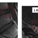극복할테야 님의 요추디스크 L4-5, 척추분리증, 전방전위증 판독입니다. 이미지