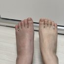 희망찬약국 | [골절일기] 인생 첫 발등골절(통깁스/비수술)_1년차 기록