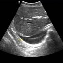 pleural effusion 이미지