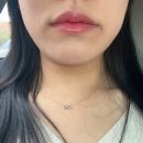 강남역성형외과 입술필러 1cc 통증 후기 추천 (가격)