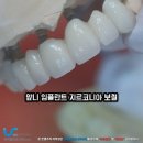 라이프치과기공소 | 앞니임플란트브릿지 앞니 지르코니아 vs 임시치아 비교