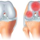 무릎 연골연화증의 증상 및 치료, 관리 이미지