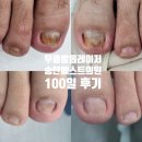 송탄의료기 | [3개월차 무좀발톱교정치료과정] 송탄베스트의원 평택 송탄출장소 지산동 서정리역 고덕신도시 안성...