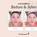 연제구-109 | 연산동윤곽관리 피부에밥주는날 | 아픔만큼 예뻐지는 리얼 볼륨윤곽관리! 1:1 맞춤 정석 케어 후기