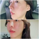 디오디피부과의원청담 | 압구정 피부과 땅콩형 얼굴에 맞는 스컬트라 2회차 후기