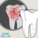 함께걸음마을치과의원 | 동편마을 치과 재신경치료, 씌운 치아가 또 아프다면?