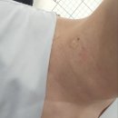 강북쥐젖제거무제한 &#34;더원뷰티 탈모&amp;셀핏바디피부&#34; 후기!!!