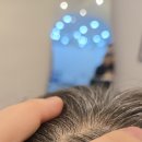 송원동로2R-7 | [구미 탈모] 모공 하나에 머리카락이 3개? 입모근 자극이 만든 '애기모'의 기적 (10회 리얼 후기)