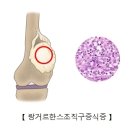 랑거한스세포 조직구증식증(Langerhans cell histiocytosis) 종양 혈액질환이란? 이미지