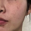 모자약국 | 색소침착 멜라토닝크림 사용법 약국 기미크림 병행관리 후기