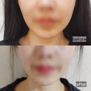 세가지소원의원 | 수원 세모아의원 티타늄리프팅+슬림핏주사 제대로 받고온 후기