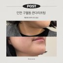 구월동 오라클피부과의원 | 인천 구월동 피부과 의원 추천, 온다리프팅 효과 및 후기