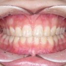 강치과의원 | 고등학생 앞니교정 후기 "앞니 콤플렉스, 졸업 전에 끝냈어요", 이아소치과