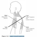 긴장성 약화와 불안정성(tightness weakness and instability) -10년 넘게 고민한 문제의 해답을 찾았다 이미지