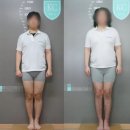 키 164→170cm.. 조주빈도 사실이었다. 키크는수술 의사 후기! 18cm 연장 키늘리는 수술한 여자 이야기
