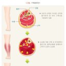 하지정맥류와 유사한 질병 - 구획증후군 (compartment syndrome) [ 하지정맥류 초기증상 - 포이즌 흉부외과 ] 이미지