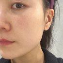 신논현역 | [신논현역피부과 내돈내산 후기] 볼뉴머 300샷 리프팅 전후 위치 정보