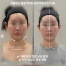 [얼굴비대칭관리 후기], 지방이식 필러보다 먼저 봐야 할 얼굴과 조직의 순환 병목 / 진접 오남 남양주...