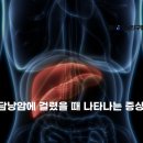 담석증 증상과 치료 이미지