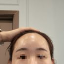 남부의원 | 나의 두번째 이마필러 후기, 관자필러&amp;보톡스 포함. 리부팅의원 필러