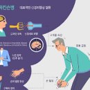 파킨슨병 초기 원인 파악 및 예방법 이미지