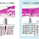 모기 침의 원리를 이용한 일본 무통 채혈침 (30G 0.4mm) 이미지